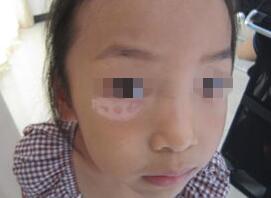 武汉脸上的白斑会给患者带来什么影响